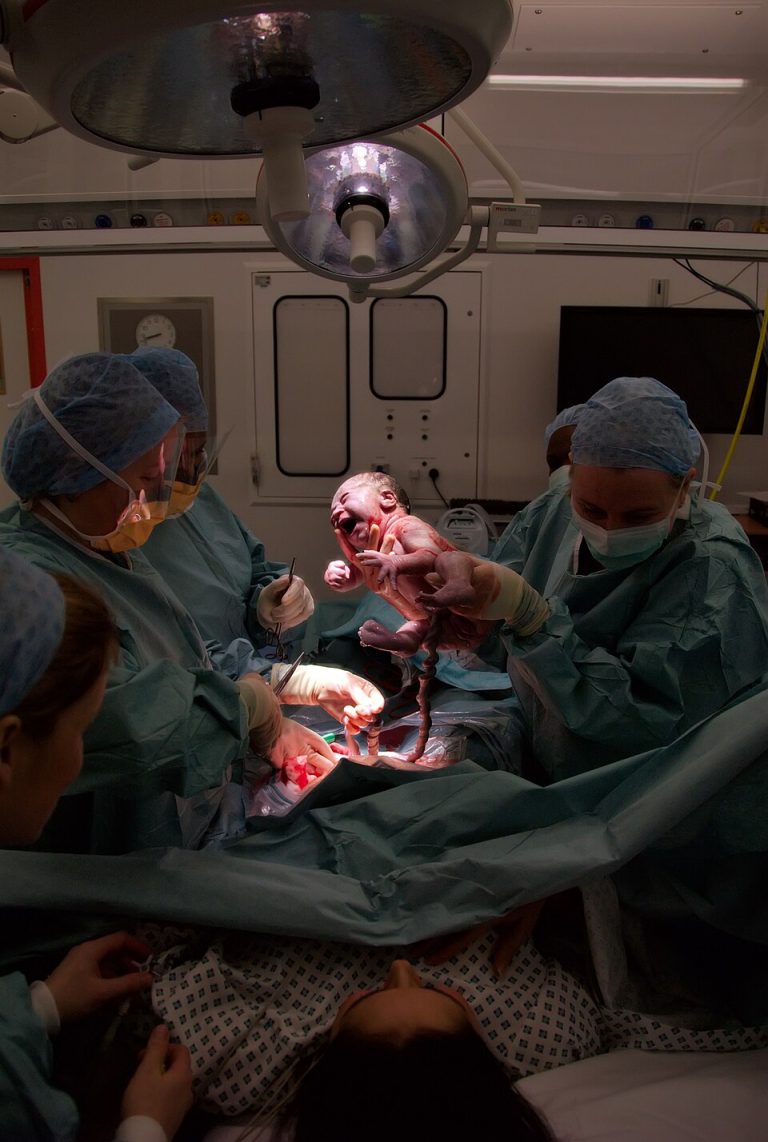 Av Salim Fadhley - Edit by DiliffThis image can be cited as:Fadhley, Salim (2014). "Caesarean section photography". Wikiversity Journal of Medicine 1 (2). DOI:10.15347/wjm/2014.006. ISSN 20018762. - Denna fil bygger på: Cesarian the moment of birth.jpg, FAL, https://commons.wikimedia.org/w/index.php?curid=4280288