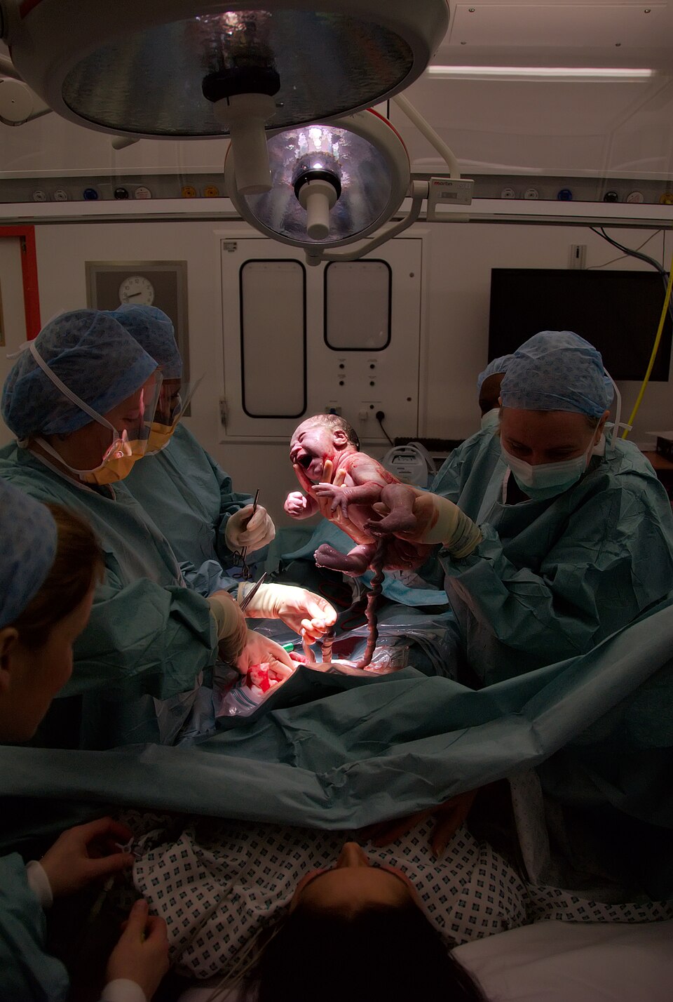 Av Salim Fadhley - Edit by DiliffThis image can be cited as:Fadhley, Salim (2014). "Caesarean section photography". Wikiversity Journal of Medicine 1 (2). DOI:10.15347/wjm/2014.006. ISSN 20018762. - Denna fil bygger på: Cesarian the moment of birth.jpg, FAL, https://commons.wikimedia.org/w/index.php?curid=4280288